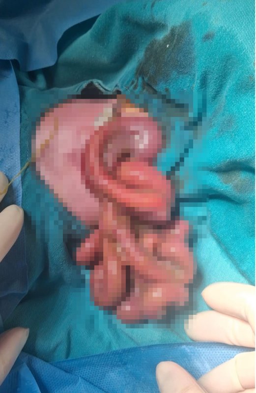 Organları dışarıda doğan bebek, Samsun'da hayata tutundu